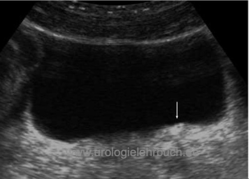 Sonographie prävesikaler Harnleiterstein