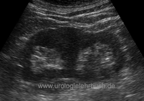 Abbildung Sonographie Doppelniere ohne Harnstau