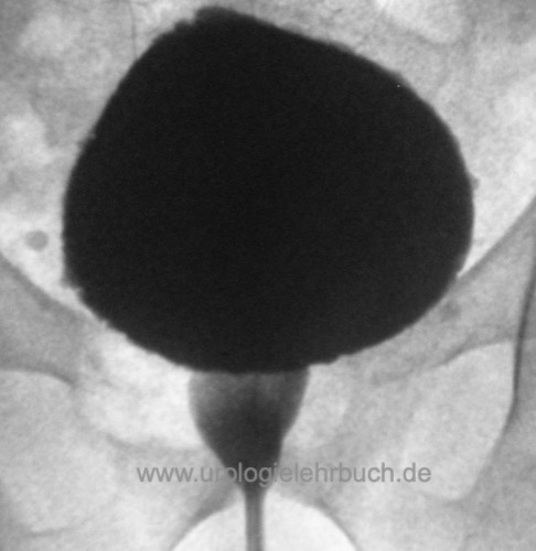 Zeichen der Detrusor-Sphinkter-Dyssynergie in der Miktionszyturethrographie