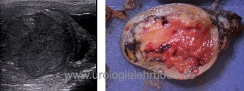 Abbildung embryonales Karzinom in der Sonographie und in der Makroskopie