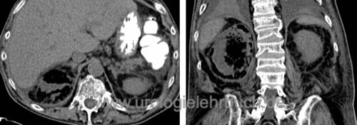 Abb. Ursache der Urosepsis 