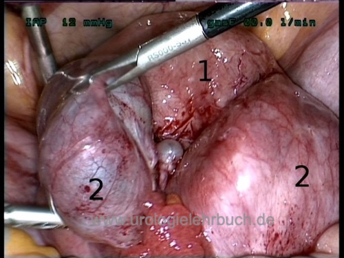 Abbildung Laparoskopie: schwere Endometriose beider Ovarien (kissing ovaries) in Laparoskopie