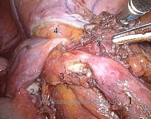 Abbildung Laparoskopie: Ureterstriktur durch Endometriose