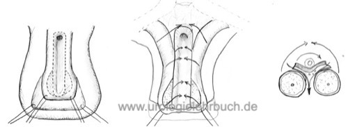 Abbildung Operationsschritte zur Korrektur einer Epispadie