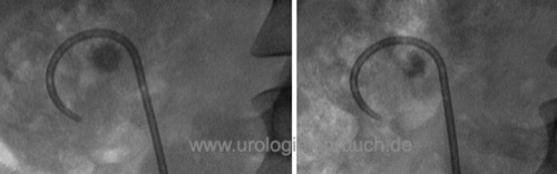 Abb. Partielle Desintegration eines rechtsseitigen Nierenbeckensteins nach einer Sitzung ESWL