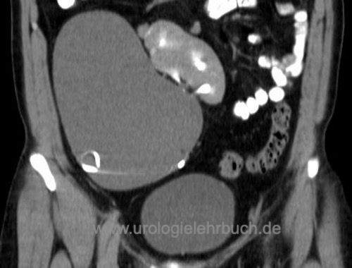 Abbildung Extrarenales Nierenbeckenkelchsystem bei einer gekreuzten Nierendystopie mit Hydronephrose