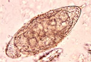 urogenitale Schistosomiasis Bilharziose Urinsediment