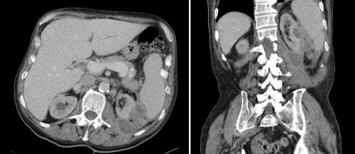 Bilderrätsel Fall 13 Fieber Flankenschmerzen CT Abdomen