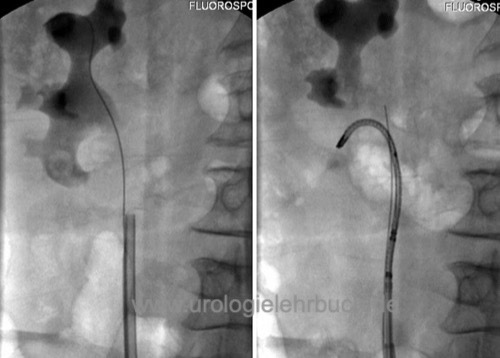 Abbildung Flexible URS mit Laserlithotripsie