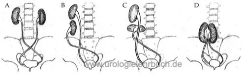 Abb. Beispiele von gekreuzten Nierendystopien A) Bilateral gekreuzte Nierendystopie B) Sigmaniere C) L-Niere D) Kuchenniere