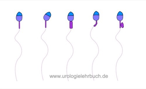 Abbildung normales Mittelstück der Spermatozoen und mögliche Mittelstückdefekte bei Teratozoospermie.