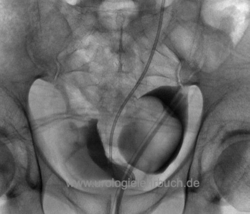 Abbildung Zystogramm eines Harnblasendivertikels
