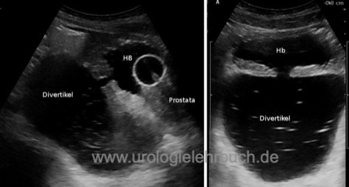 Sonographie eines Harnblasendivertikels.