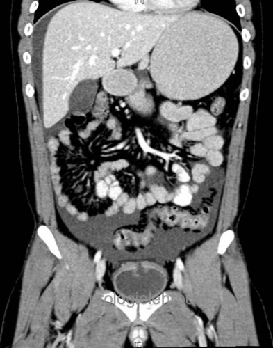 Abb. CT einer intraperitonealen Harnblasenruptur