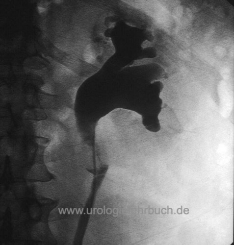 retrograde Pyelographie Nierenbeckenkarzinom und Harnleiterkarzinom