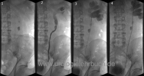 Abbildung DJ-Harnleiterschienung bei großem linksseitigem Harnleiterstein