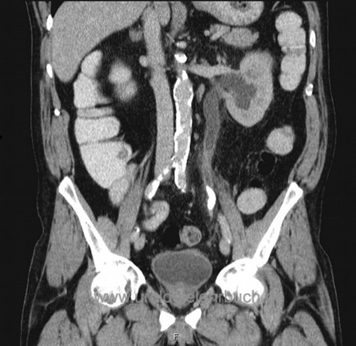 CT Abdomen nativ mittlerer Harnleiterstein links mit Harnstau