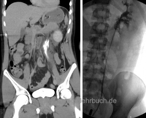 Abbildung Harnleiterverletzung links CT-Abdomen (Spätphase) und retrograde Pyelographie