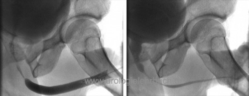 Abbildung Retrograde Urethrgraphie (links) und MCU (rechts) einer kurzstreckigen bulbären Harnröhrenstriktur.