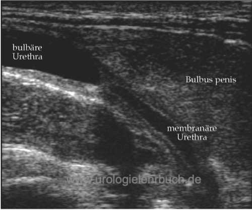 Abbildung: perineale Sonographie einer kurzstreckigen bulbären Harnröhrenstriktur mit geringer Fibrose.