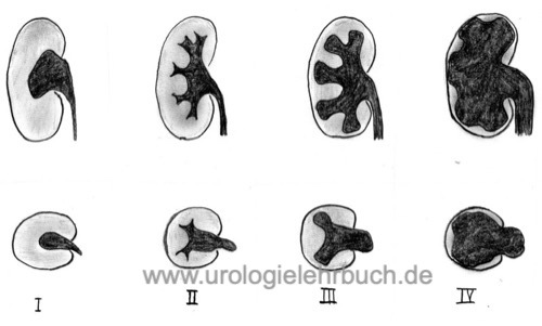 Abbildung Sonographische Einteilung der Hydronephrose in Grad I–IV