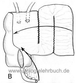 Abbildung heterotope Harnableitung Mainz-Pouch I