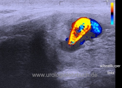 Abbildung Doppler-Sonographie bei High flow-Priapismus