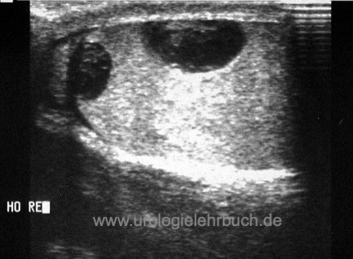 Ultraschall (Sonographie) eines intratesticulären Hämatoms