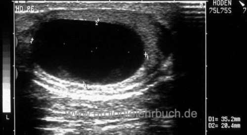 Abbildung einfache Hodenzyste in der Sonographie