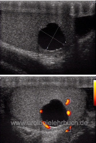 Abbildung einfache Hodenzyste in der Farbduplex Sonographie