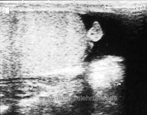 Abb. Sonographie einer Hydatidentorsion