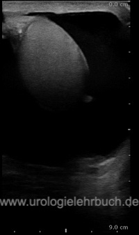 Abbildung: Sonographie einer Hydrozele testis (Wasserbruch)