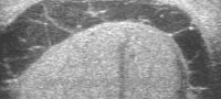 gekammerte Hydrozele bei Epididymitis