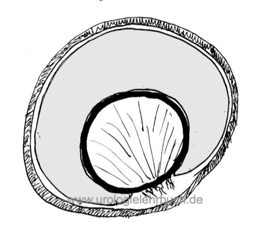 Abbildung: Hydrozele schematisch