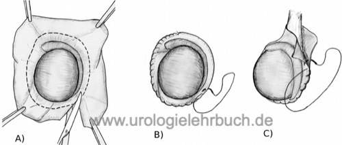 OP Hydrozelen-Operation mit Exzision der Hüllen nach von Bergmann oder Winkelmann