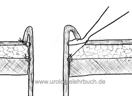 Hautnähte für ein Ileum-Conduit mit nippelförmigem Stoma.