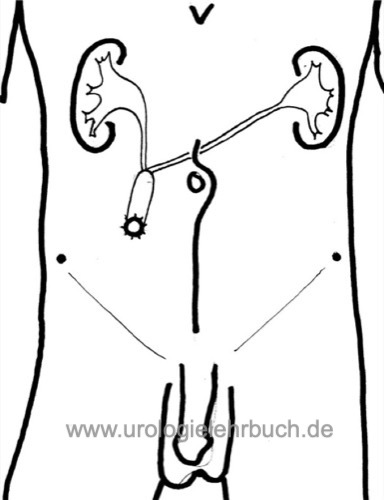 Abbildung ileum conduit