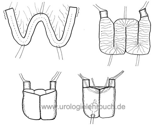 Ileum Neoblase nach Hautmann Harnableitung nach Zystektomie Harnblasenkarzinom