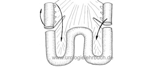 Abbildung 1: kontinenter Ileumpouch als Harnableitung nach Zystektomie Harnblasenkarzinom