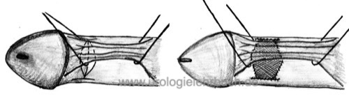 Abbildung: Operation der Penisdeviation mit Grafting