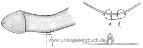 Abbildung Operationstechnik der Penisdeviation nach Essed und Schroeder