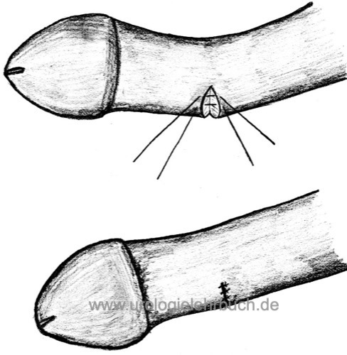 Abbildung Operationstechnik der Penisdeviation nach Nesbit