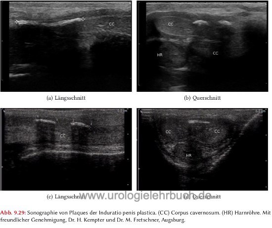 Abbildung Sonographie von Plaques der Induratio penis plastica