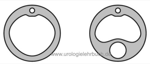 Abb. Querschnitt von transurethralen Dauerkatheter (2-Wege) und Harnblasen-Spülkatheter (3-Wege)