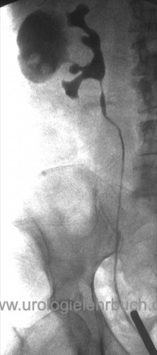 Kelchdivertikel in der retrograden Pyelographie