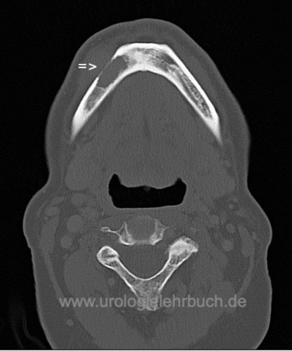 Abbildung Kieferosteonekrose unter Therapie mit Zoledronsäure