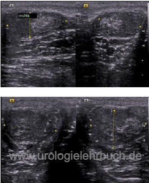 Abbildung Hodensonographie bei einem Patienten mit Klinefelter-Syndrom