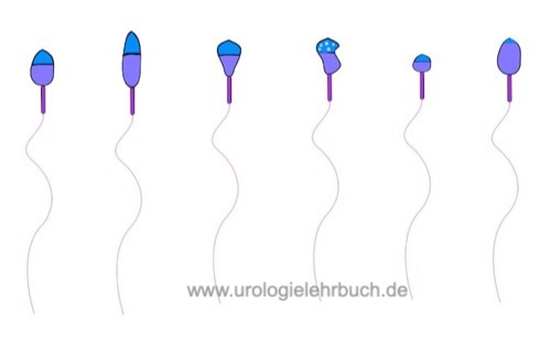 Abbildung normal Kopfform der Spermatozoen und mögliche Kopfdefekte bei Teratozoospermie.
