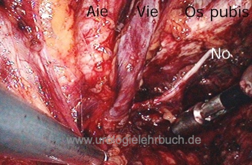 laparoskopische pelvine Lymphadenektomie Bergung Lymphknoten Fossa obturatoria ilacae externae N. obturatorius