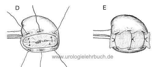 Abbildung laparoskopische Technik der Blutstillung